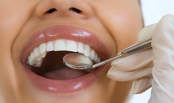 Dentist examining a smile after tooth colored filing treatment