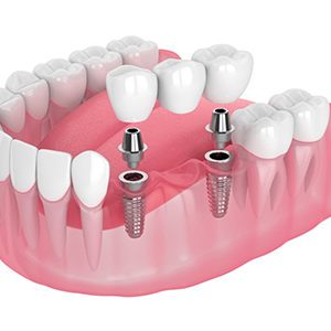 a 3D illustration of a dental implant bridge