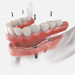 a 3D example of all-on-4 dentures