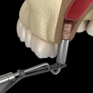 a digital illustration of a sinus lift 