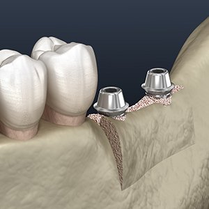 a digital illustration of a ridge expansion 