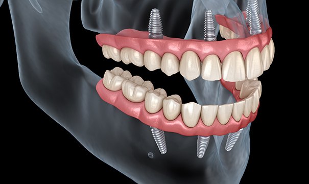 Illustration of All-on-4 in Attleboro, MA for upper and lower jaw