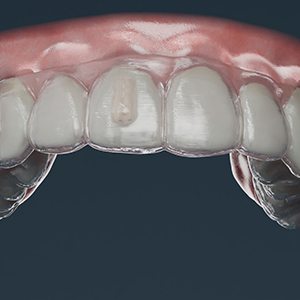 Up close view of teeth and clear aligner