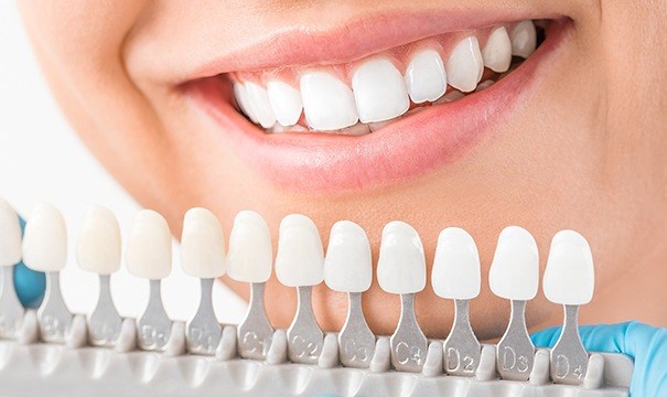 Smile compared to porcelain veneer color chart