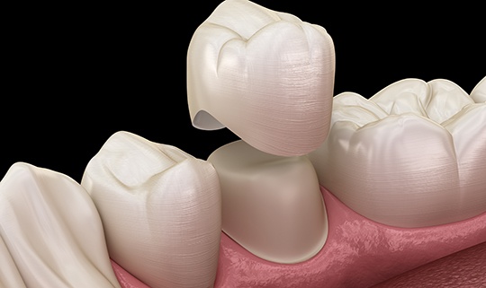 Model smile with dental bridge