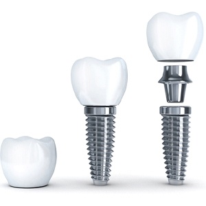 dental implant crown, abutment, and post