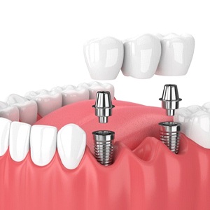 dental bridge being placed onto two dental implant posts