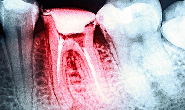 X-ray showing tooth in need of extraction highlighted red