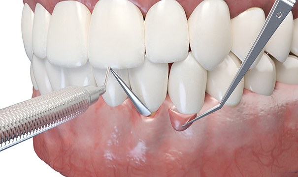 illustration of gum grafting procedure 