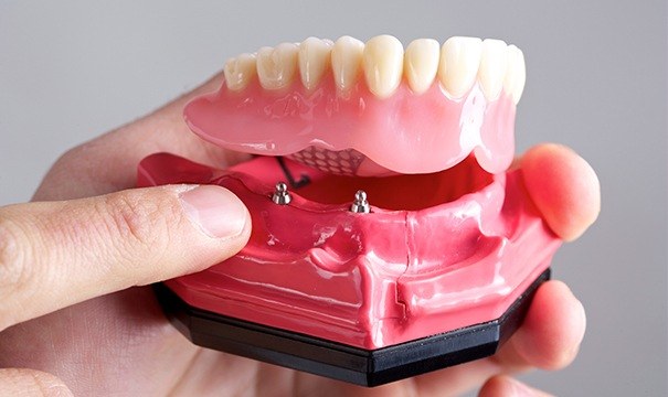 Model dental implant denture in hand