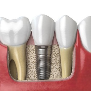 a 3 D illustration of a dental implant