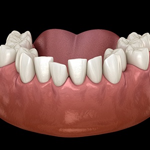 Illustration of crooked teeth