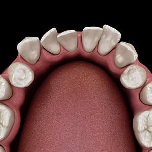 Illustration of gapped teeth