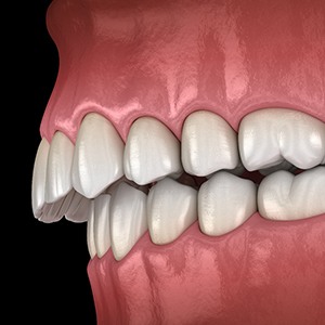 Illustration of overbite