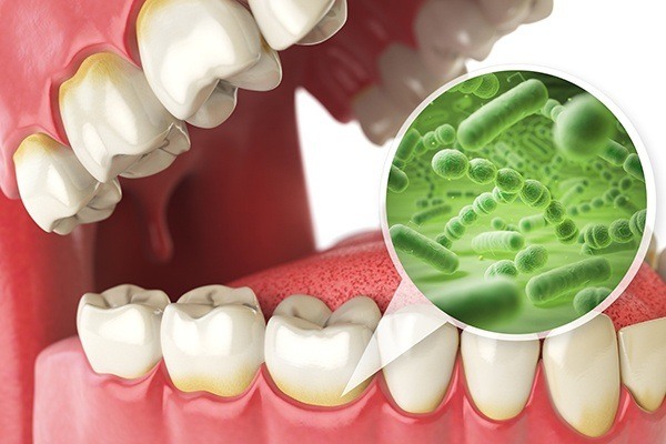 Bacteria in mouth graphic