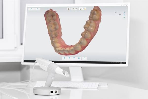Digital smile impression for clear braces treatment planning