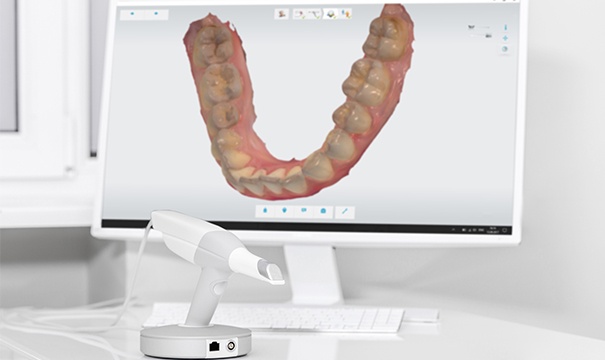 Trios 3D scanner images on computer screen
