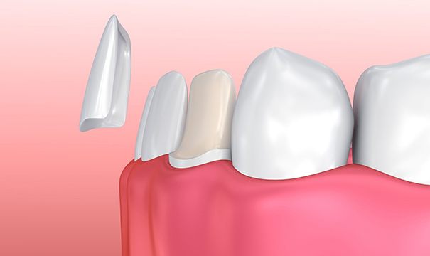 diagram of veneer being placed on tooth