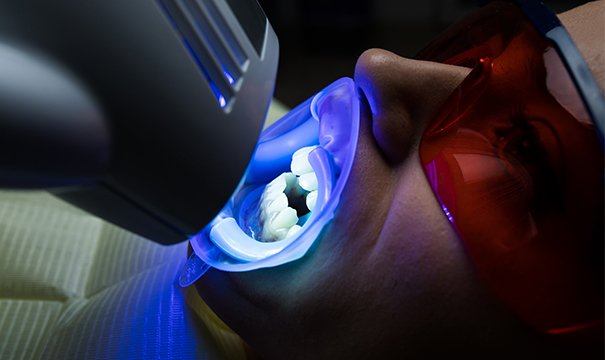 woman getting in office teeth whitening