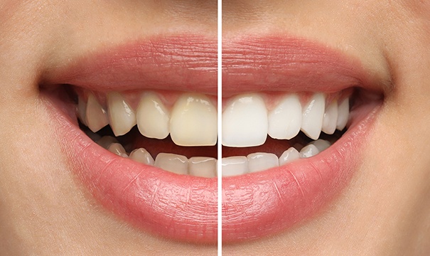 Closeup of patient's smile before and after teeth whitening