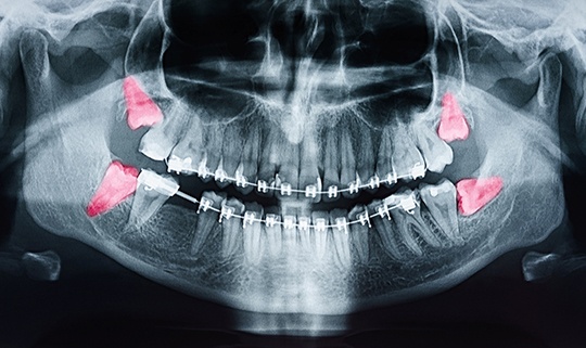 X-ray of wisdom teeth in Attleboro