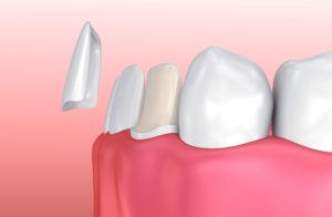 Model of veneers for lower tooth