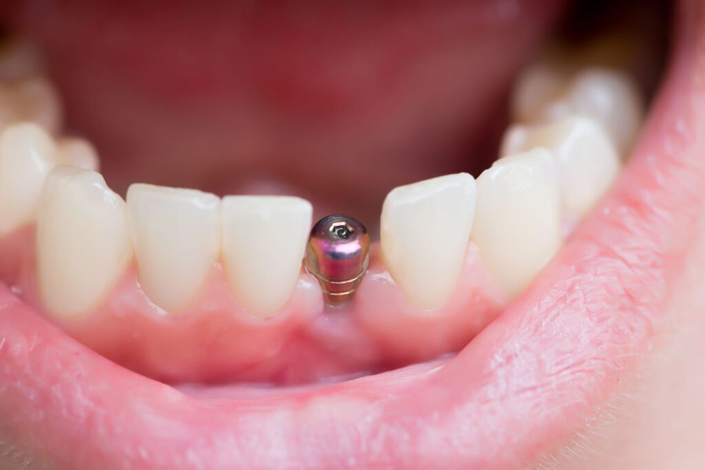 Closeup of dental implant rod inserted in lower arch