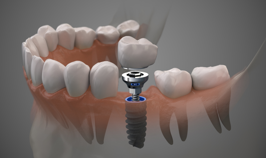 3D Image of a dental implant