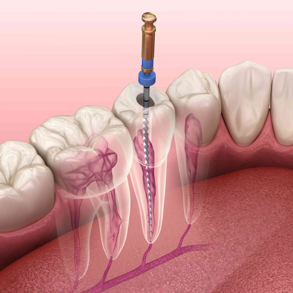 Illustration of root canal treatment